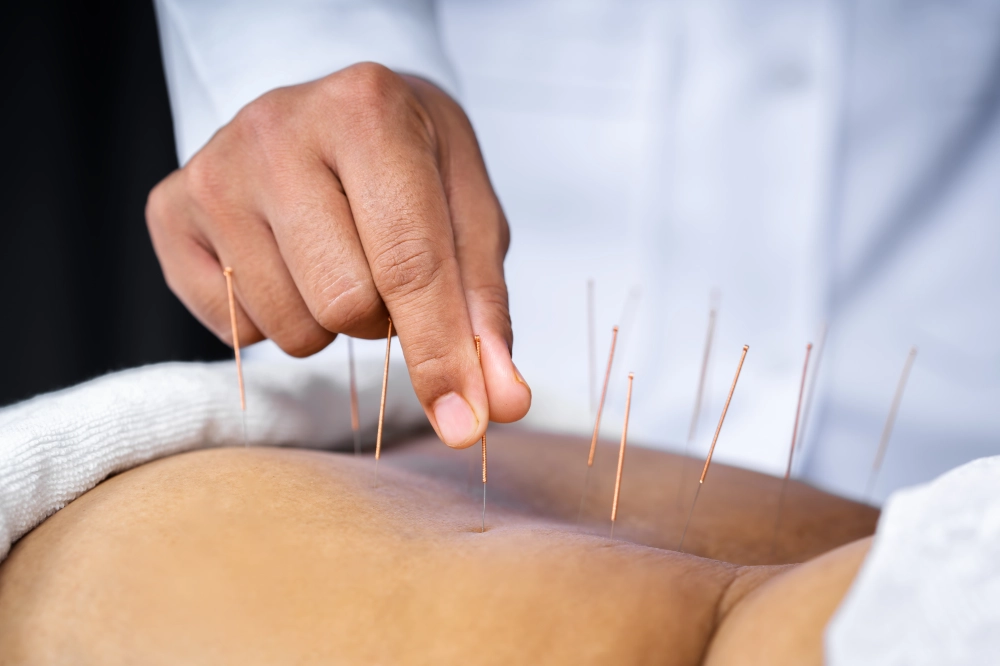 dry-needling-elite-physical-therapy